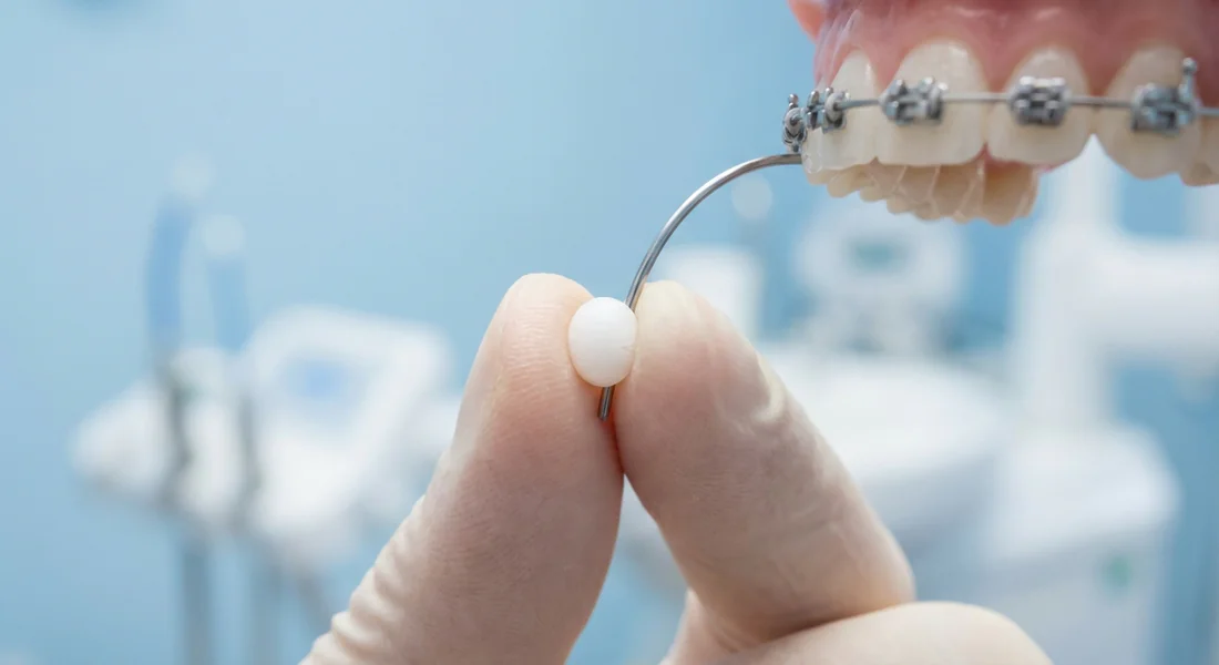Application de cire orthodontique de protection sur un fil qui pique